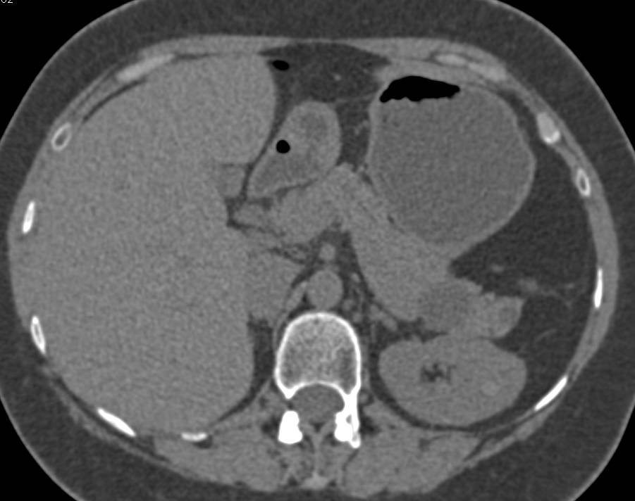 Intraductal Papillary Mucinous Neoplasm (IPMN) and Multiple High Density Renal Cysts - CTisus CT Scan