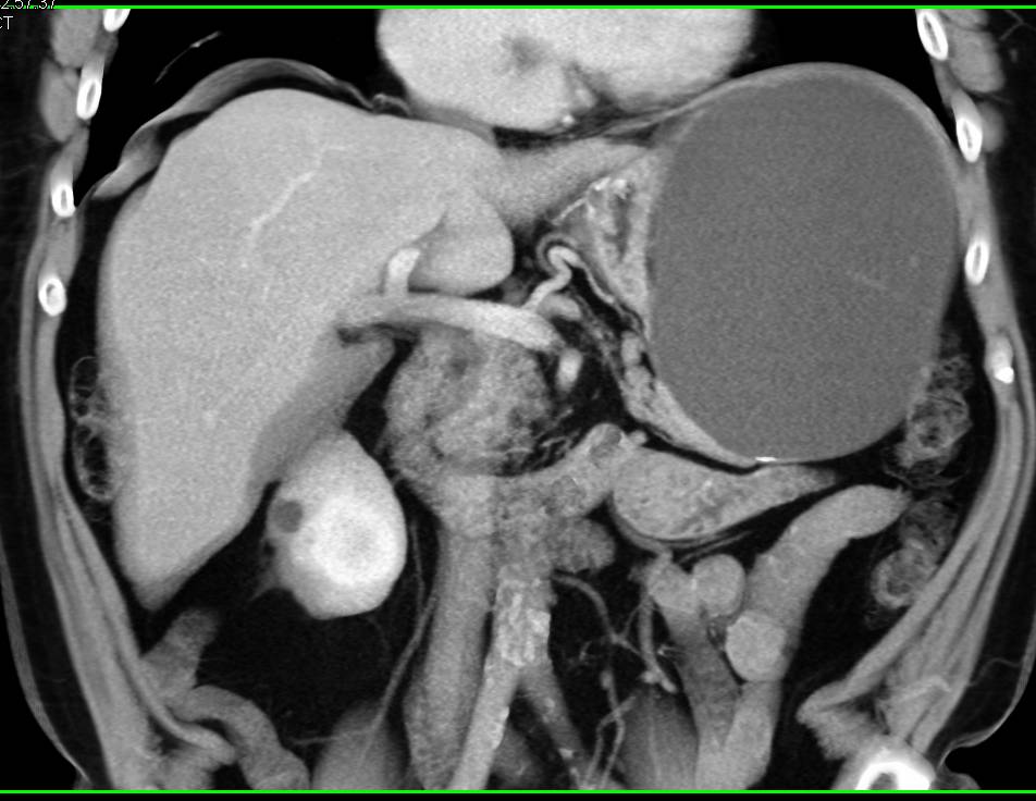 Serous Cystadenoma of the Tail of the Pancreas - CTisus CT Scan