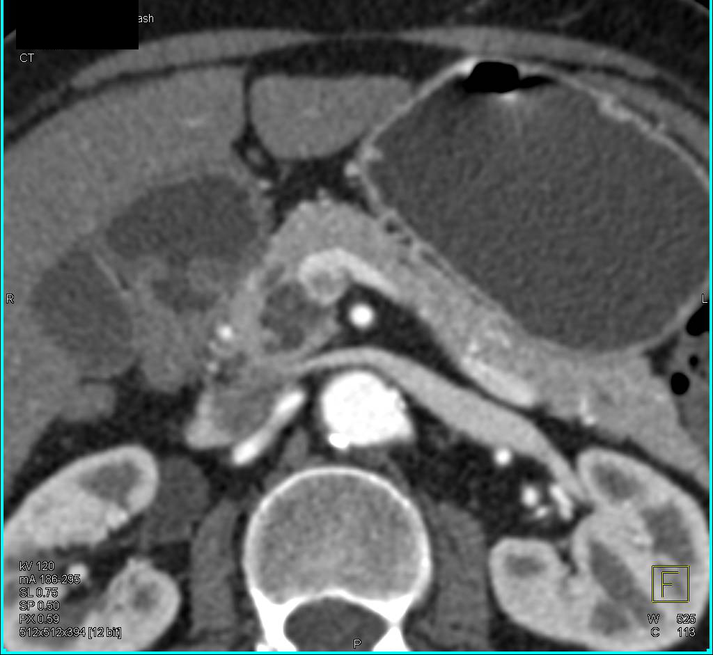 Intraductal Papillary Mucinous Neoplasm (IPMN) With Thin Septations - CTisus CT Scan