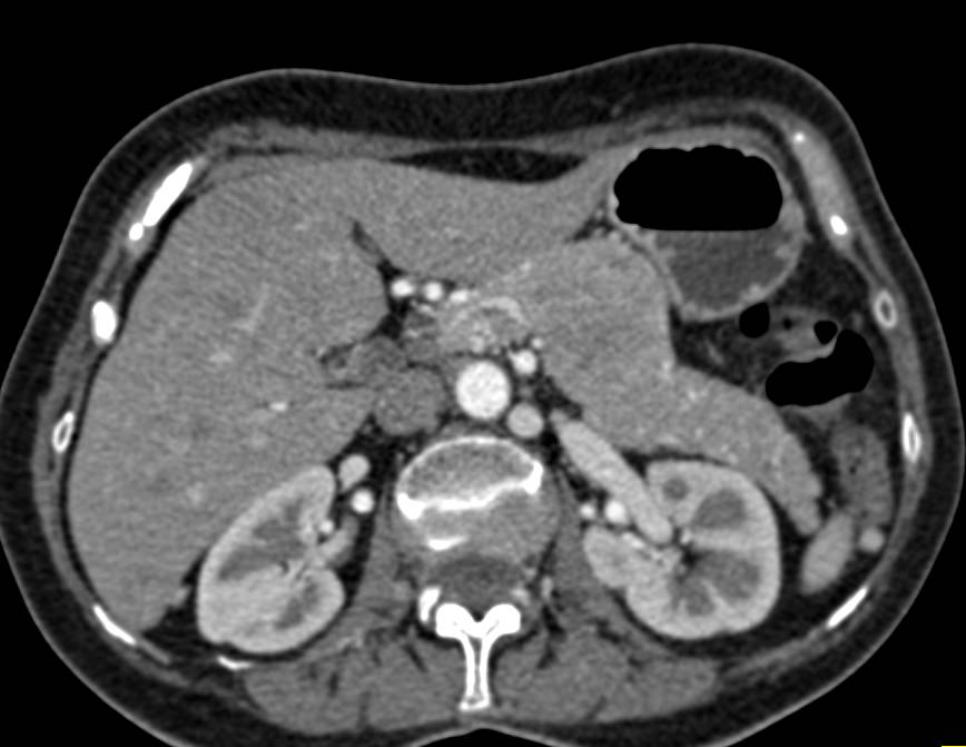 Atypical Neuroendocrine Tumor of the Body of the Pancreas - CTisus CT Scan