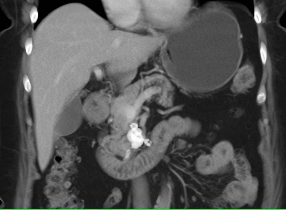 Chronic Pancreatitis with Calcifications in the Head of the Pancreas - CTisus CT Scan