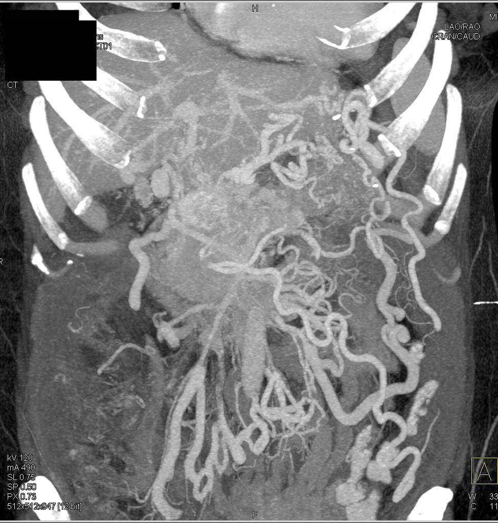 Neuroendocrine Tumor in the Head of the Pancreas with Collaterals - CTisus CT Scan