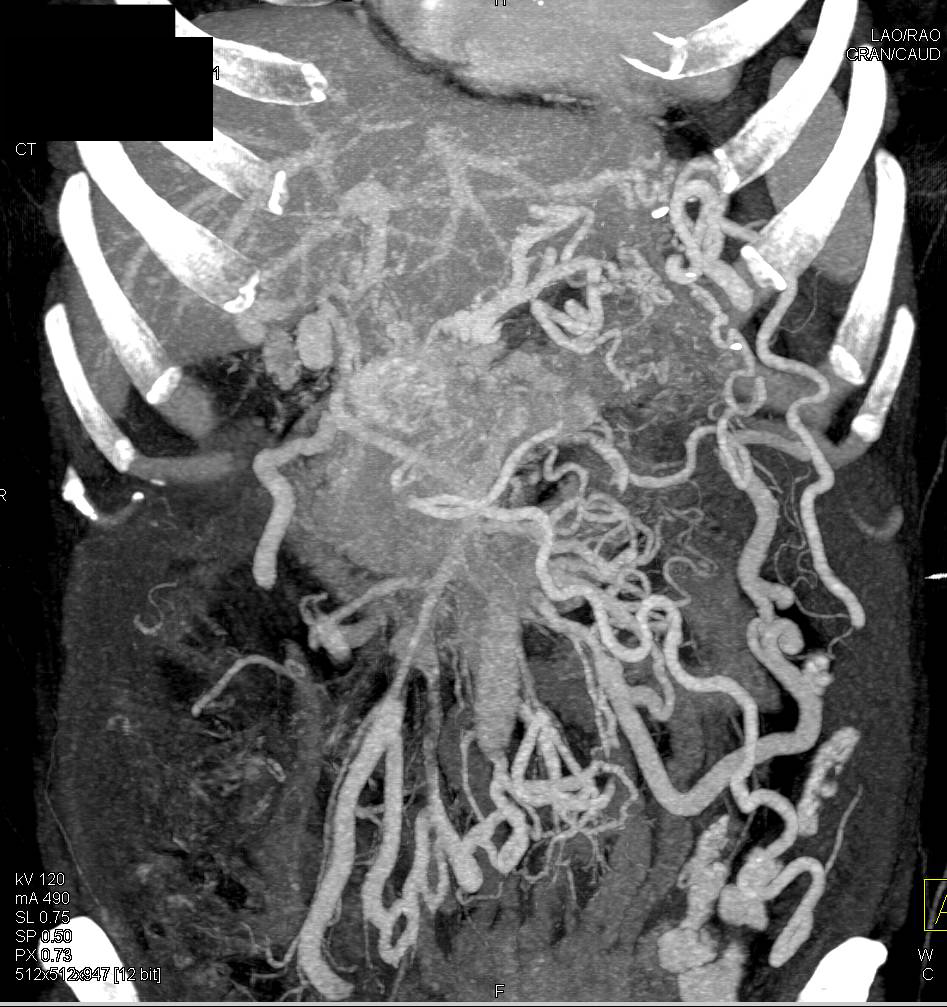 Infiltrating Pancreatic Cancer with Venous Encasement and Extensive Collaterals - CTisus CT Scan