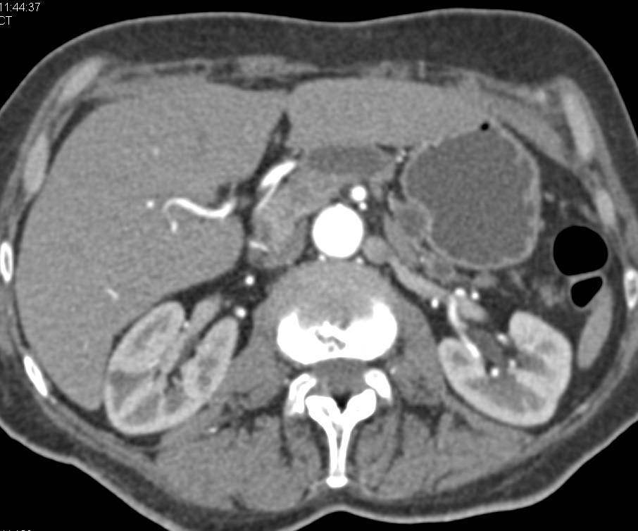 Pancreatic Cancer Obstructs the Pancreatic Duct - CTisus CT Scan