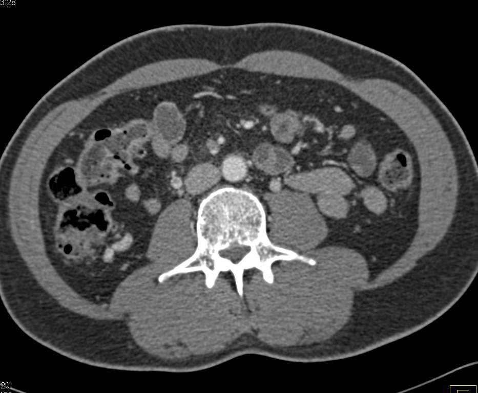 Pancreatic Cancer with Encased PV/SMV Confluence - CTisus CT Scan