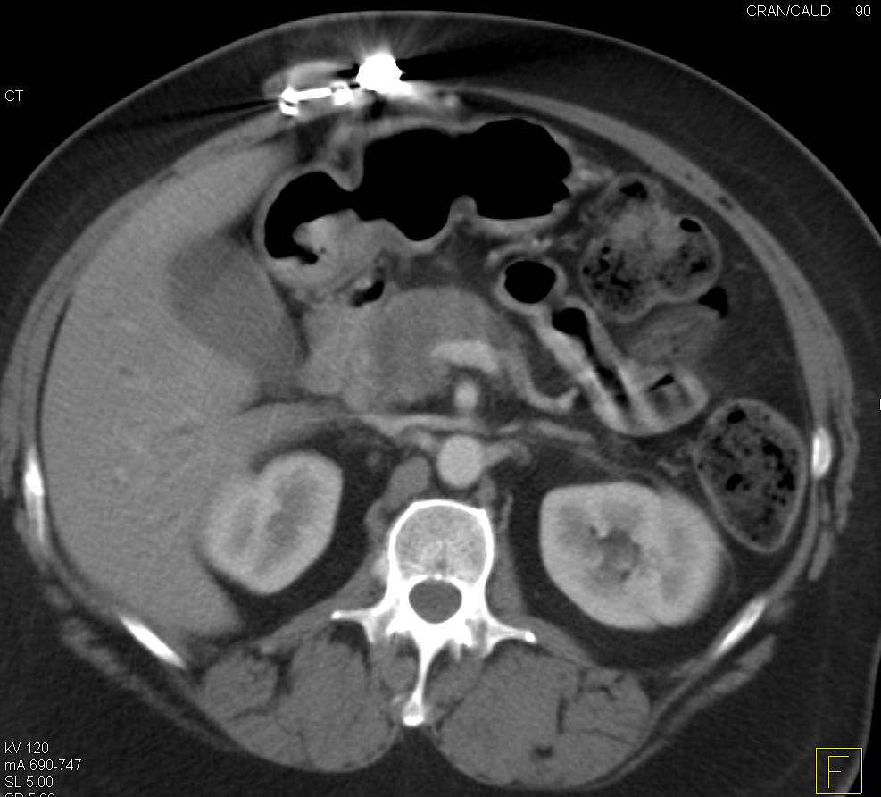 Infiltrating Pancreatic Cancer - CTisus CT Scan