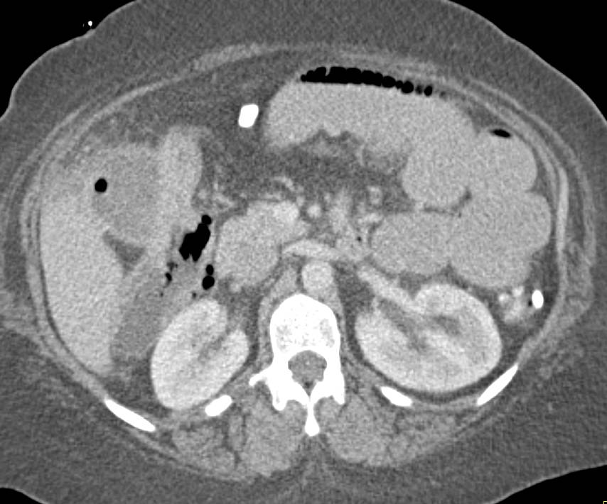 Endoscopic Retrograde Cholangiopancreatography (ERCP) Perforation with Free Air Near Duodenum - CTisus CT Scan