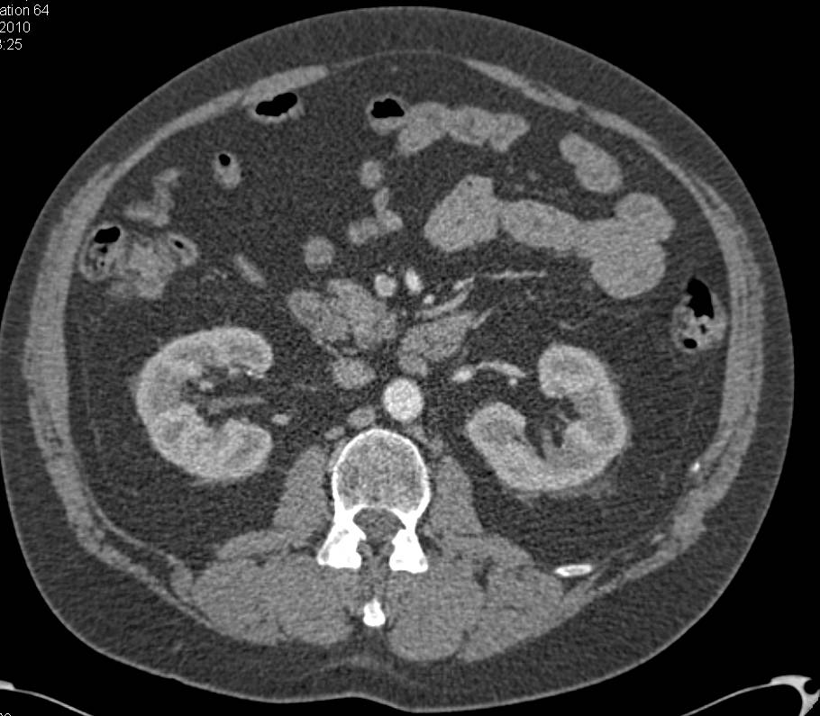 Neuroendocrine Tumor in the Tail of the Pancreas with Liver Metastases - CTisus CT Scan