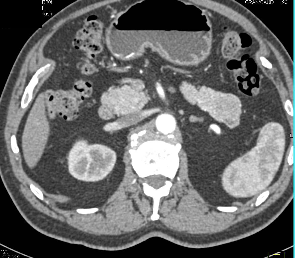 Neuroendocrine Tumor in Tail of Pancreas - CTisus CT Scan