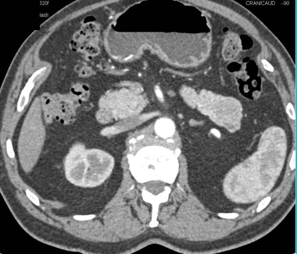 Neuroendocrine Tumor in Tail of Pancreas - CTisus CT Scan