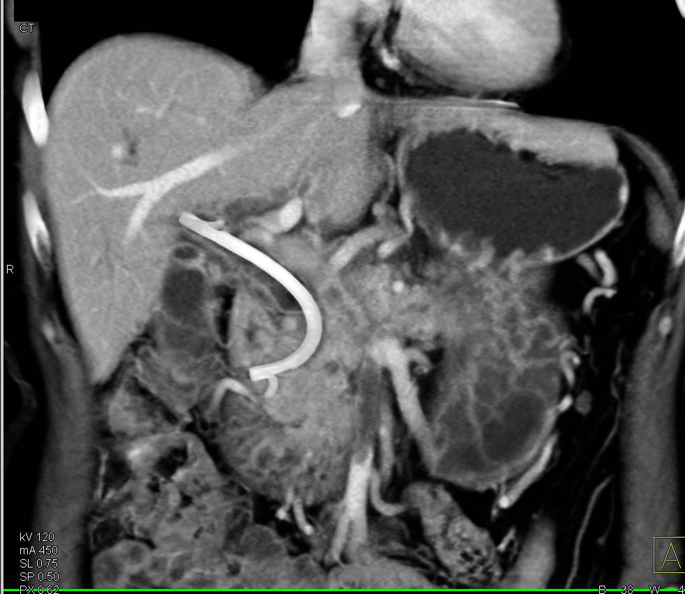 Pancreatic Cancer with Superior Mesenteric Vein (SMV) Thrombus - CTisus CT Scan