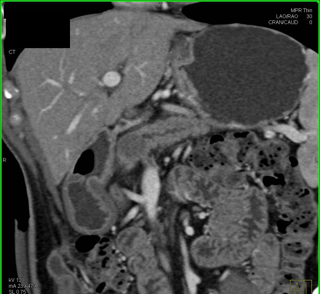 Metastatic Sarcoma to the Pancreas Simulates a Primary Pancreatic Neoplasm - CTisus CT Scan