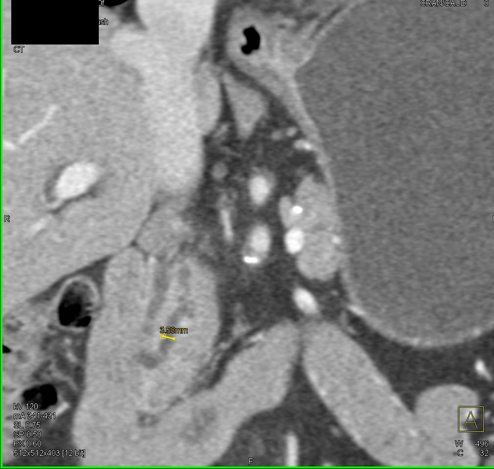 Intraductal Papillary Mucinous Neoplasm (IPMN) with Dilated Pancreatic Duct and Common Bile Duct - CTisus CT Scan