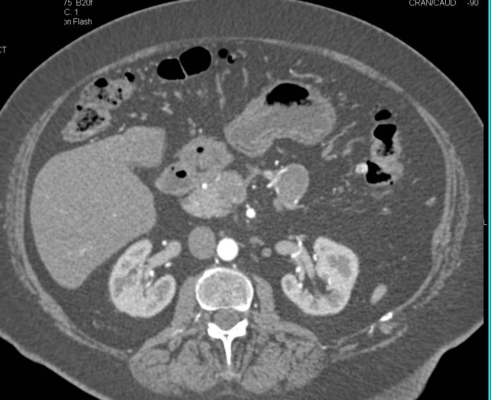 Cystic Neuroendocrine Tumor - CTisus CT Scan