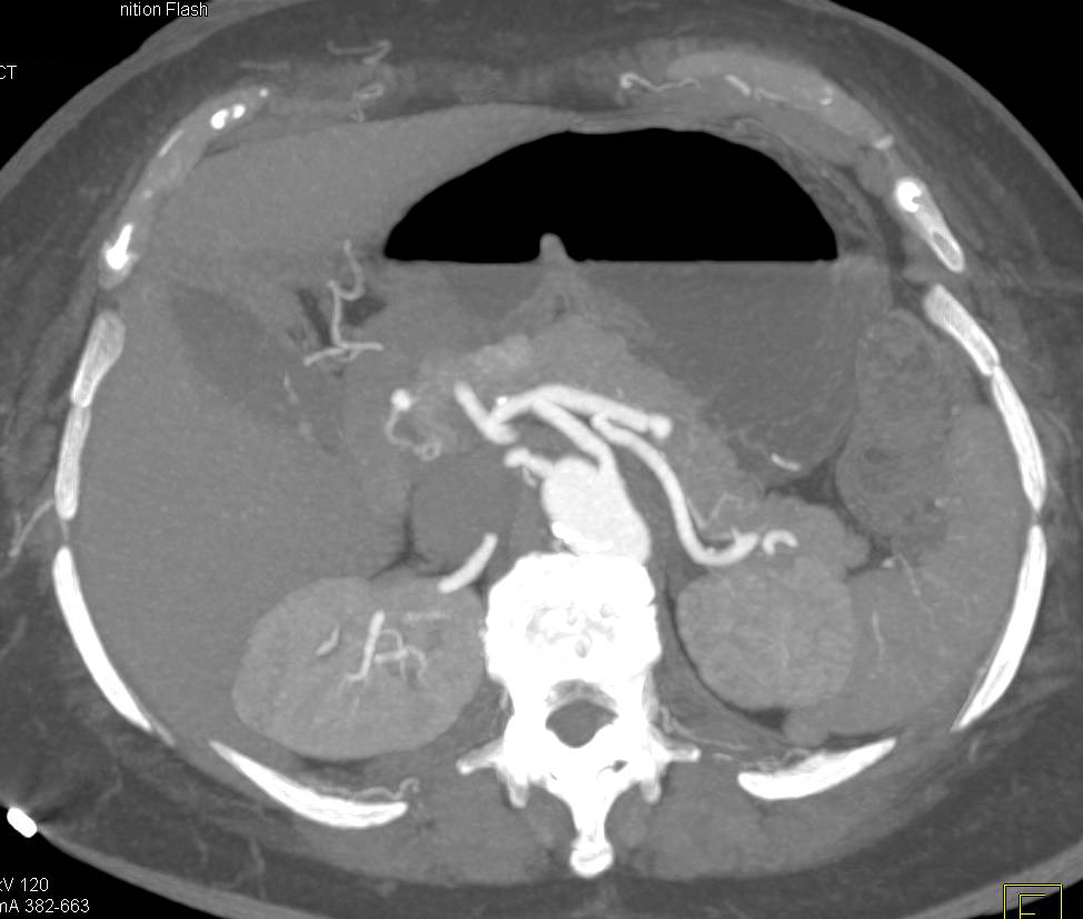 Neuroendocrine Tumor in the Body of the Pancreas (see all phases) - CTisus CT Scan