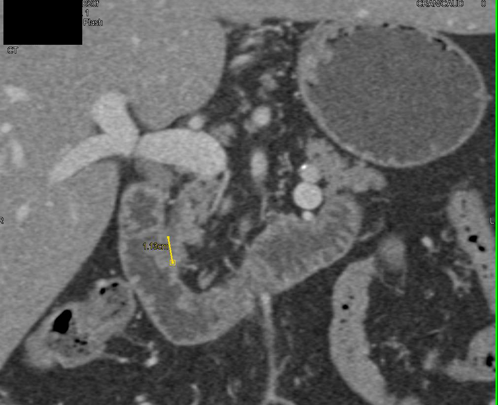 Ampullary Carcinoma - CTisus CT Scan