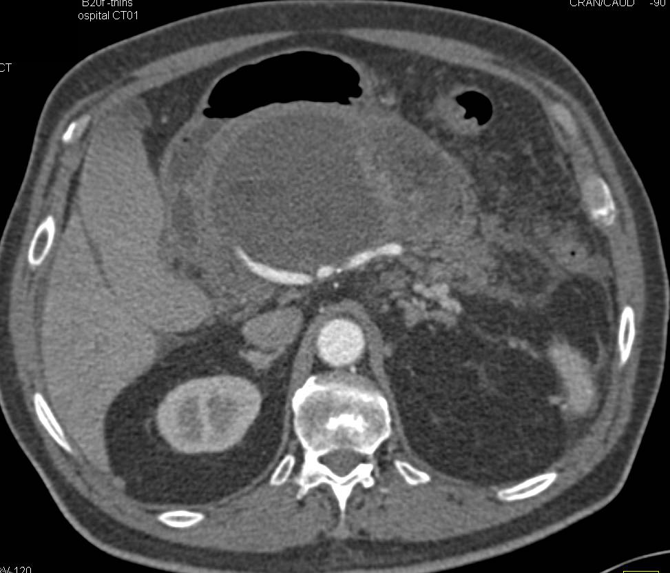 Acute Pancreatitis with Pancreatic Necrosis Occurs in a Patient with a History of Chronic Pancreatitis - CTisus CT Scan