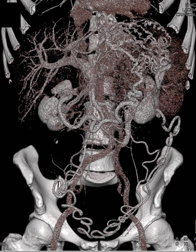 Neuroendocrine Tumor in the Body/Tail of the Pancreas (see all phases) Occludes the Splenic Vein with Incredible Collaterals - CTisus CT Scan