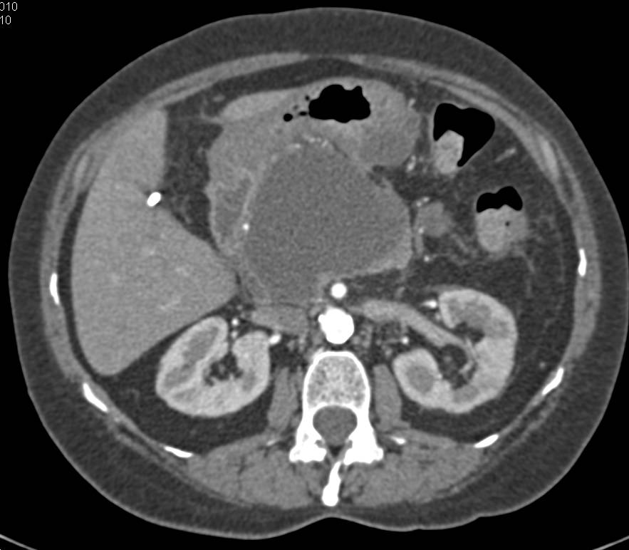 Pancreatic Pseudocyst Compresses the Stomach and Local Vessels - CTisus CT Scan