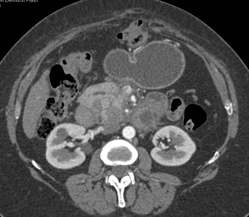 Pancreatic Cancer with Encasement of Portal Vein (PV) and Superior Mesenteric Vein (SMV) - CTisus CT Scan