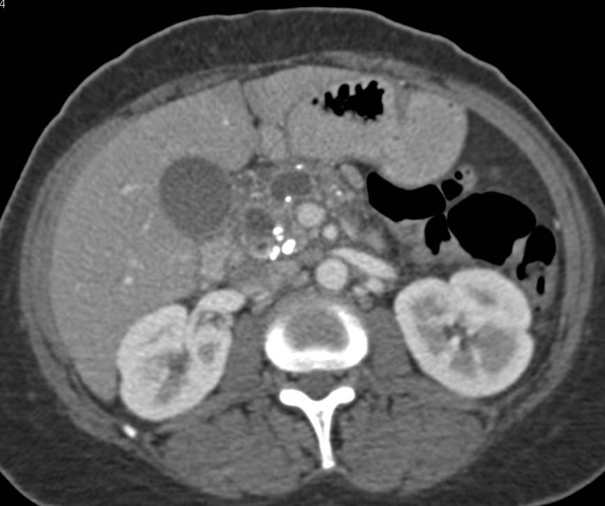 Chronic Pancreatitis with Calcifications in the Pancreas and Dilated Duct - CTisus CT Scan