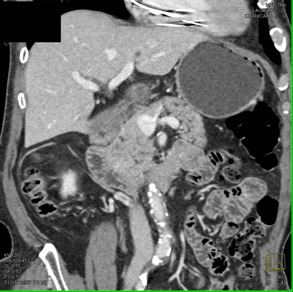 Focal Fatty Infiltration of the Pancreas Simulates a Mass - CTisus CT Scan