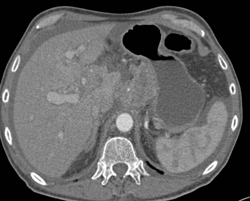 Pancreatic Adenocarcinoma with Vascular Invasion and Extensive Adenopathy - CTisus CT Scan