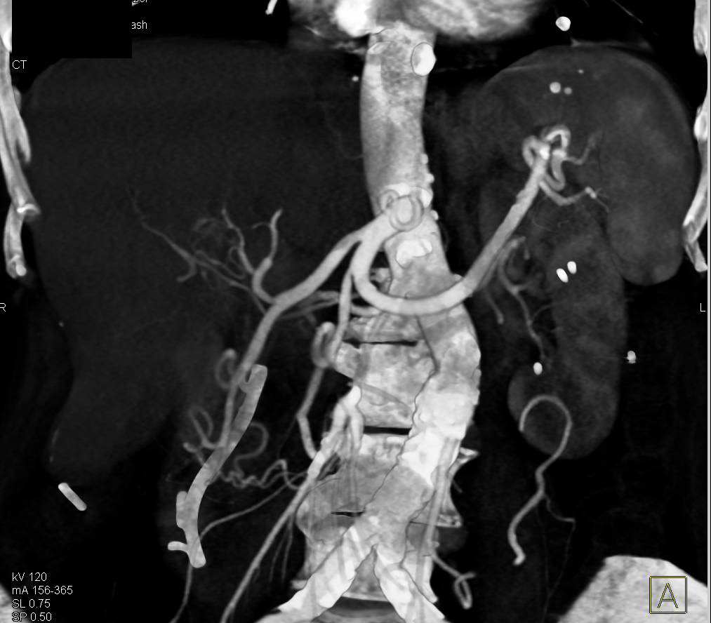 Intraductal Papillary Mucinous Neoplasm (IPMN) in Head of Pancreas - CTisus CT Scan