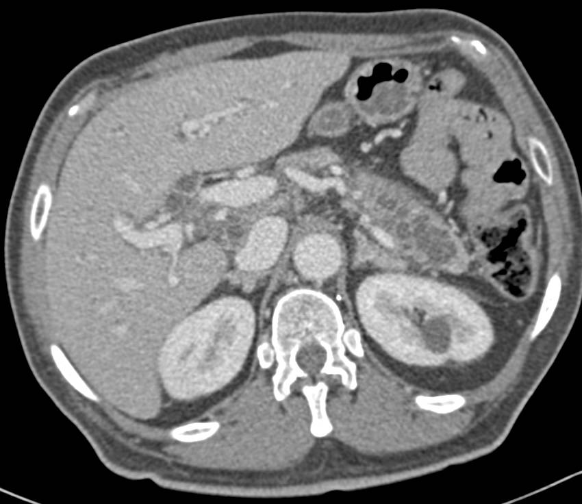 Multiple Intraductal Papillary Mucinous Neoplasms (IPMNs) - CTisus CT Scan