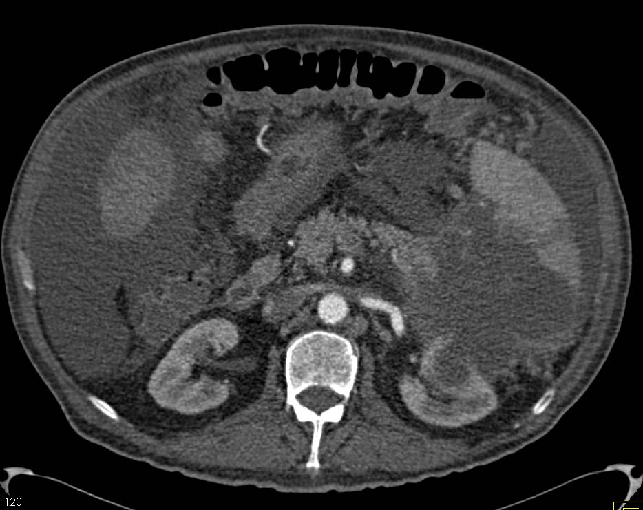 Carcinoma of the Tail of the Pancreas Invades the Spleen with Liver Metastases also seen - CTisus CT Scan