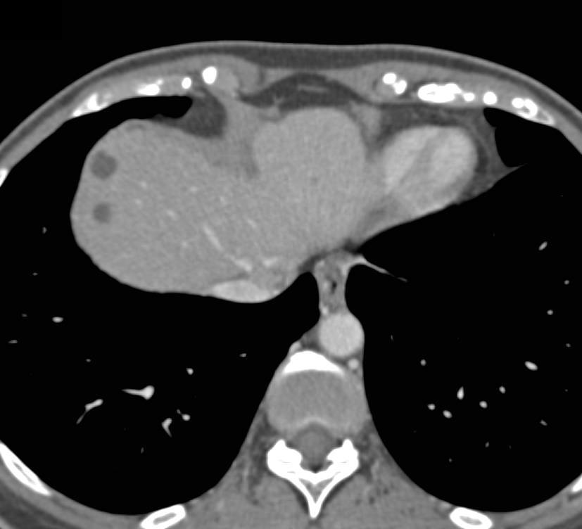 Pancreatic Cancer with Encasesment of Portal Vein (PV) and Cavernous Transformation of the Portal Vein (CTPV) with Varices and Collaterals - CTisus CT Scan