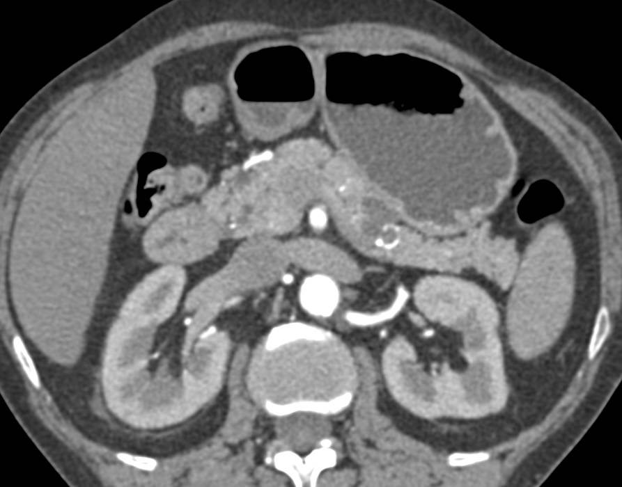 Intraductal Papillary Mucinous Neoplasm (IPMN) - CTisus CT Scan