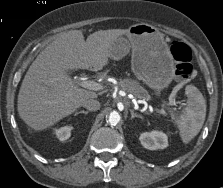 Pancreatic Cancer Encases the Celiac Axis with Implants Near Hepatic Flexure as well - CTisus CT Scan