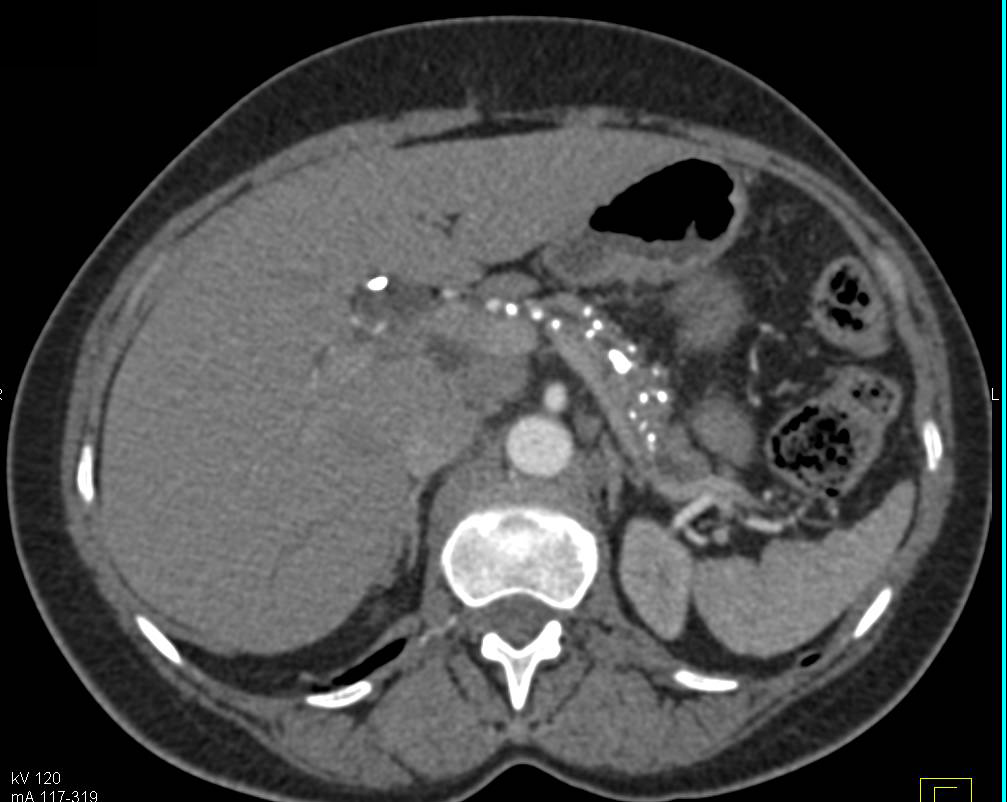 Chronic Pancreatitis with Calcifications in the Pancreas and Dilated Duct - CTisus CT Scan