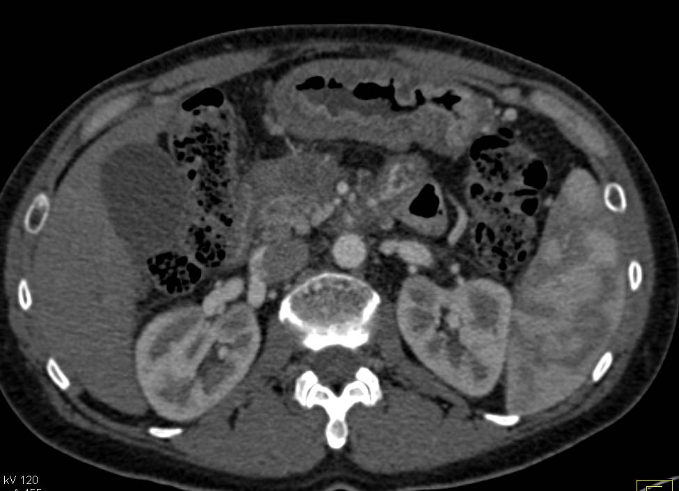 Pancreatic Cancer Encases PV/SMV Junction with Collaterals - CTisus CT Scan