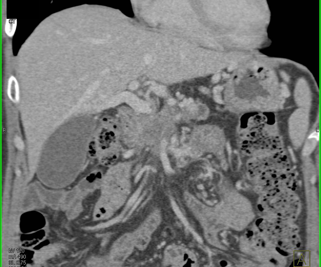 Pancreatic Cancer with PV/SMV Encasement - CTisus CT Scan