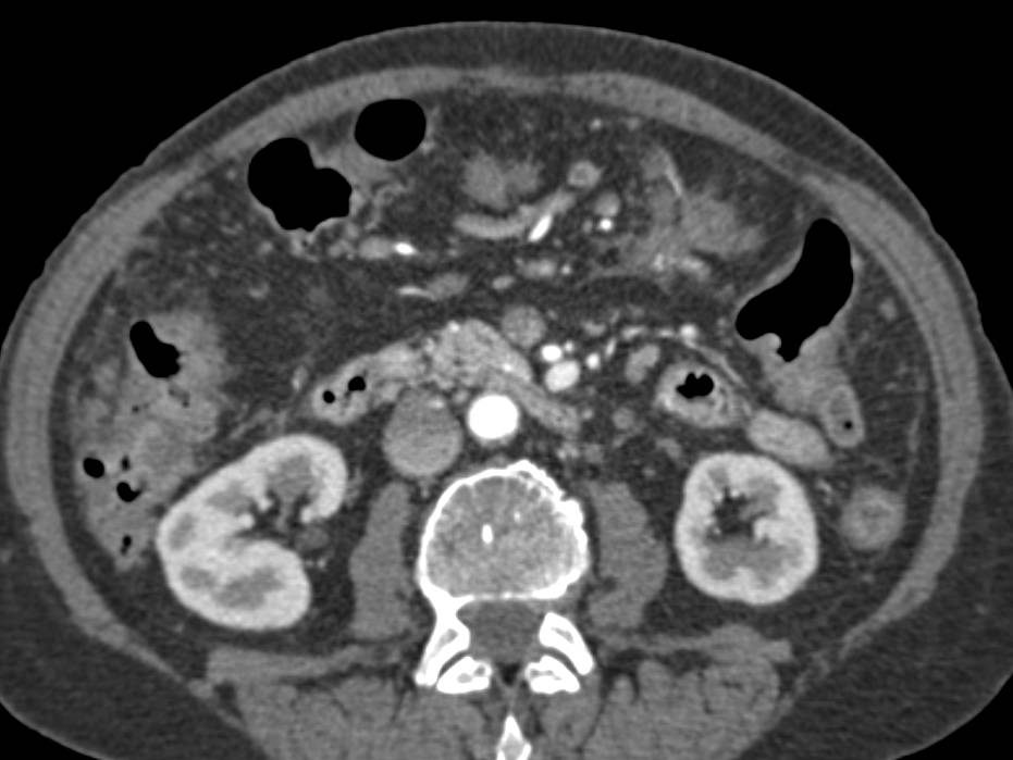 Carcinoma of the Body of the Pancreas with Carcinomatosis and Liver Metastases - CTisus CT Scan