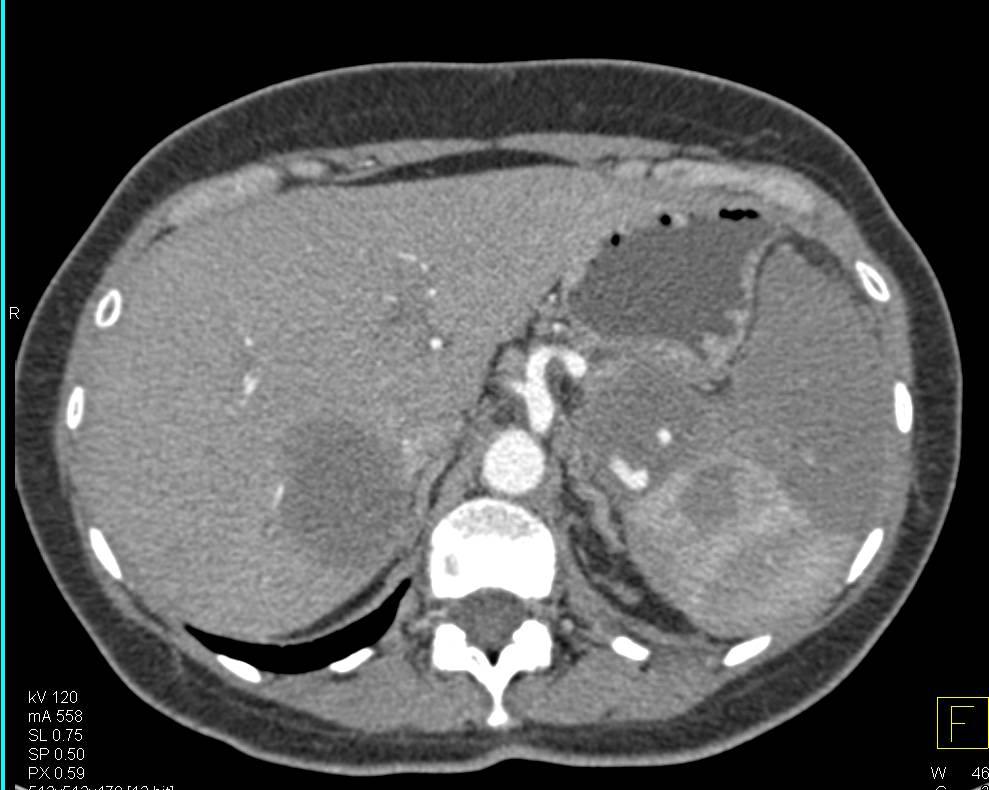 Adenocarcinoma of the Tail of the Pancreas with Liver Metastases and Splenic Metastases and Splenic Infarction - CTisus CT Scan