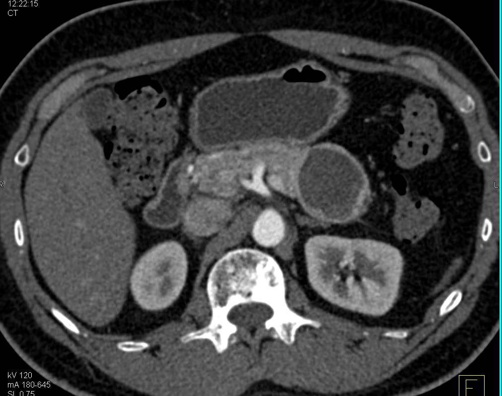 Cystic Neuroendocrine Tumor - CTisus CT Scan