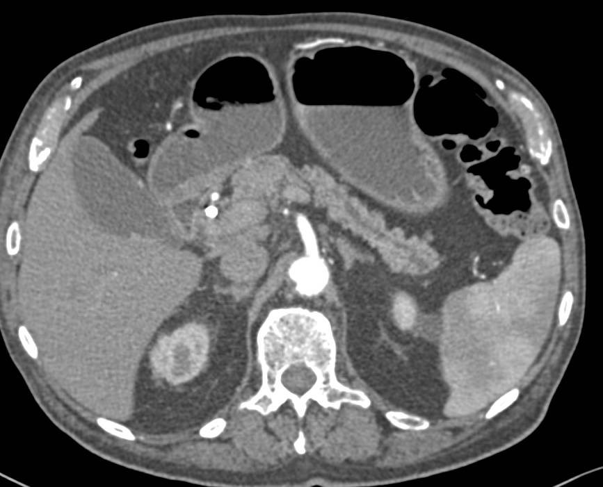 Adenocarcinoma Arises in the Main Pancreatic Duct. This is a Carcinoma Arising in an Intraductal Papillary Mucinous Neoplasm (IPMN) - CTisus CT Scan