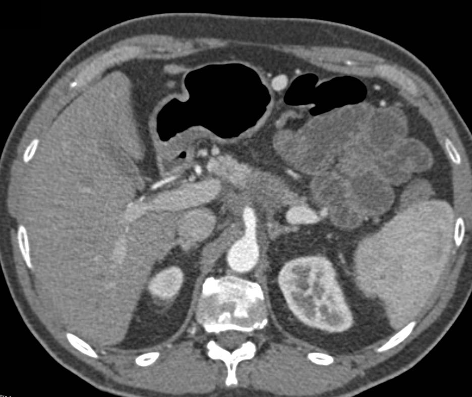 Carcinoma of the Body of the Pancreas Encases the Celiac Artery - CTisus CT Scan