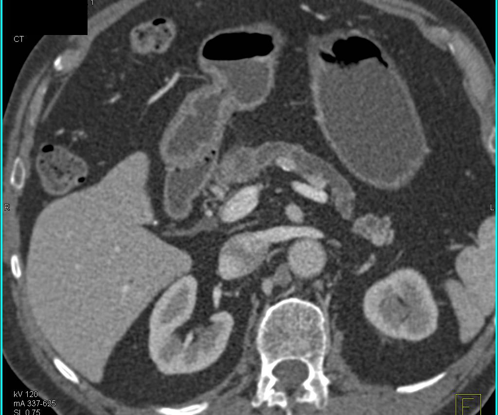 Subtle Pancreatic Cancer Obstructs the Pancreatic Duct - CTisus CT Scan