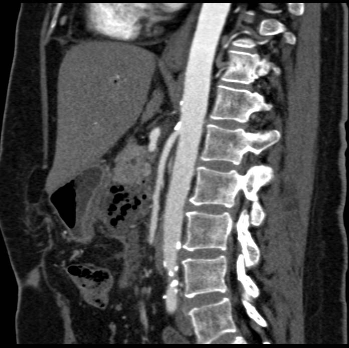 Pancreatic Abscess and Superior Mesenteric Artery (SMA) Syndrome - CTisus CT Scan