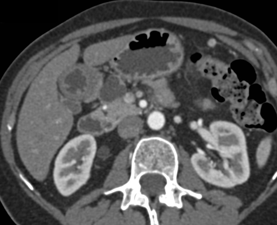 Intraductal Papillary Mucinous Neoplasm (IPMN) in Head of the Pancreas - CTisus CT Scan