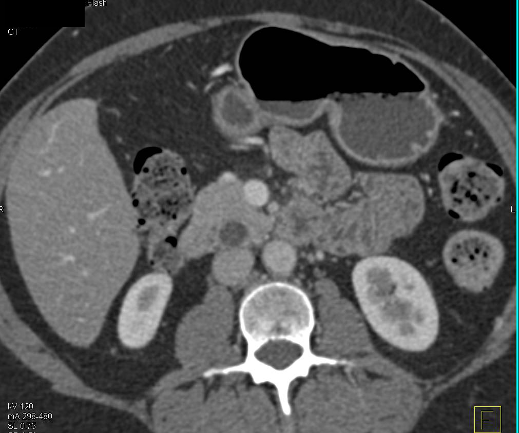 Intraductal Papillary Mucinous Neoplasm (IPMN) in Head of Pancreas - CTisus CT Scan