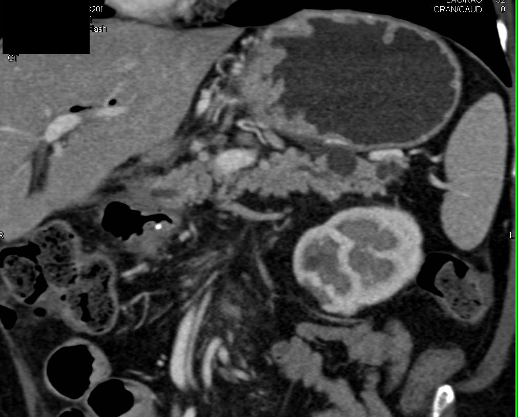 Intraductal Papillary Mucinous Neoplasm (IPMN) - CTisus CT Scan