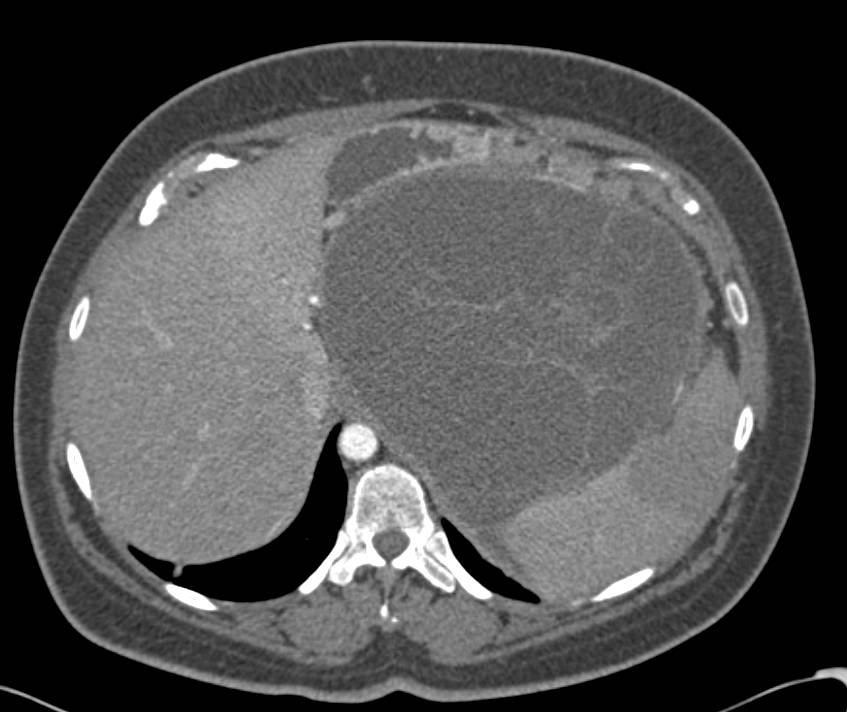 Serous Cystadenoma of the Tail of the Pancreas - CTisus CT Scan