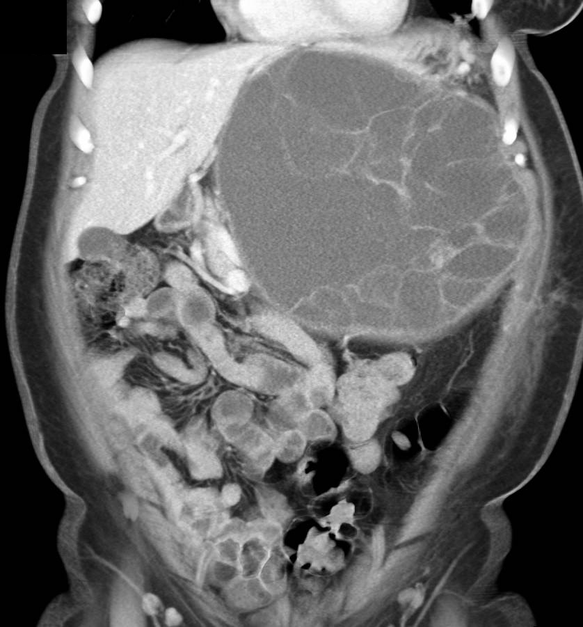 Serous Cystadenoma Tail of the Pancreas - CTisus CT Scan