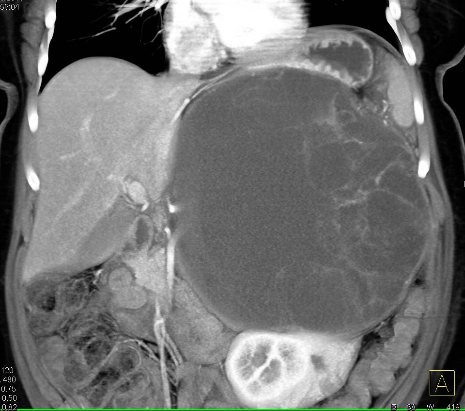 Serous Cystadenoma Tail of the Pancreas - CTisus CT Scan