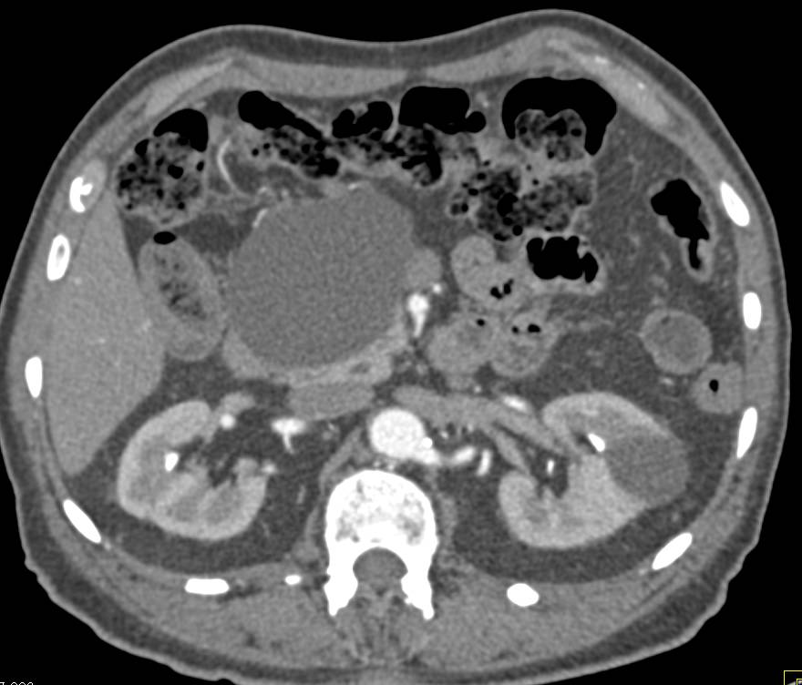 Pancreatic Pseudocyst - CTisus CT Scan